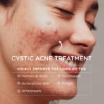 Cystic Acne Treatment for Face: Hormonal Acne Treatment Cream for Teens & Adults - Salicylic Acid & Tea Tree Oil Pimple Spot Remover - Anti-Acne Moisturizer Reduces Redness, Blemishes - Image 4