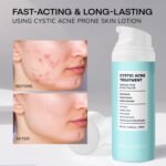 Cystic Acne Treatment for Face: Hormonal Acne Treatment Cream for Teens & Adults - Salicylic Acid & Tea Tree Oil Pimple Spot Remover - Anti-Acne Moisturizer Reduces Redness, Blemishes - Image 6