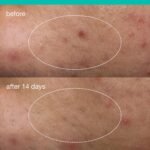 Dermalogica Deep Acne Liquid Patch, Sulfur Acne Treatment with Niacinamide, Invisible Spot Treatment for Blemish-Prone Skin – 0.5 fl oz - Image 4