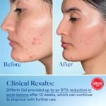 Differin Acne Treatment Gel, 30 Day Supply, Retinoid Treatment for Face with 0.1% Adapalene, Gentle Skin Care for Acne Prone Sensitive Skin, 15g Pump (Packaging May Vary) - Image 7