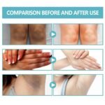 Acanthosis Nigricans Therapy Cream,Dark Spot Remover For Body,Dark Spot Corrector Cream,- Underarm, Neck, Armpit, Knees, Elbows, Private Areas, Intimate Areas - Upgraded Formula, - 2.1Fl Oz - Image 6